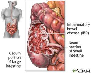 IBD diagram